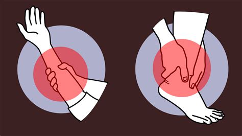 Compartment syndrome and Volkmann’s ischemic contracture: the real emergency of a swollen limb