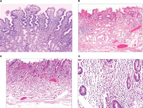 Frontiers | Early onset, development and histological features of gastric signet-ring cell carcinoma