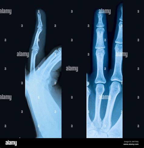 Xray Broken Finger