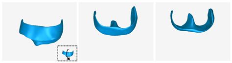 CBCT-Based Design of Patient-Specific 3D Bone Grafts for Periodontal ...