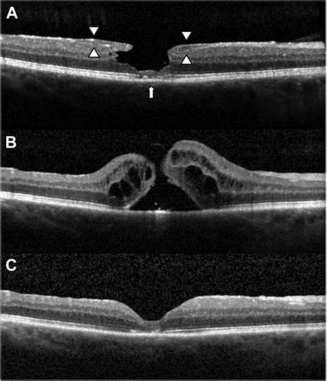 Natural History and Surgical Outcomes of Lamellar Macular Holes - Ophthalmology Retina