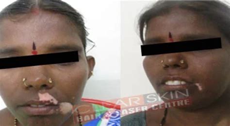 Targeted Phototherapy For Skin In Kurnool, Bangalore, Hyderabad and India