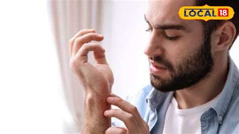 Home Remedies for Heat Rash: গৰমৰ বাবে শৰীৰত ঘামচি দেখা দিছে নেকি ...