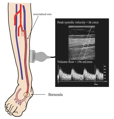 Volume Flow and Peak Systolic Velocity of the Arteriovenous Circuit in ...
