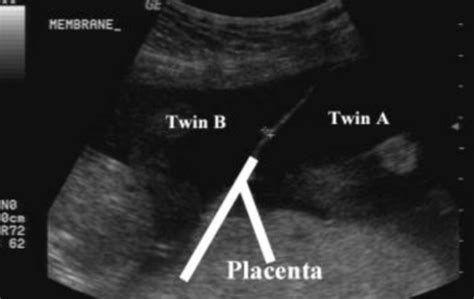 Image result for Billing Coding for Multiple Fetus