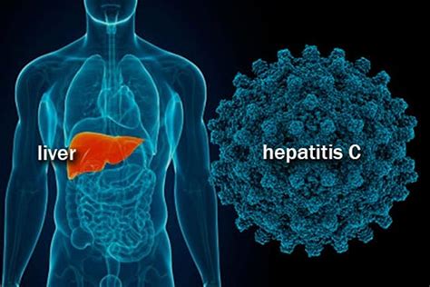 Hepatitis C is curable