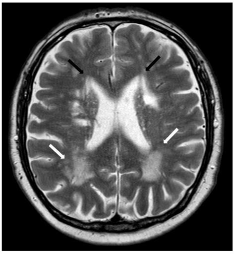 Neuroradiological Findings in Cerebral Amyloid Angiopathy with a ...