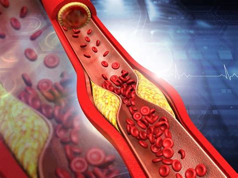 Heart Blockage: Top 7 Foods That Can Help Prevent Clogged Arteries ...