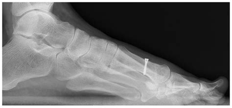 Scarf Osteotomy for Hallux Valgus Deformity. A Prospective Study with 8 ...