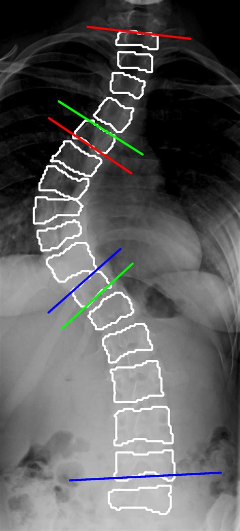 Scoliosis X Ray Cobb Angle