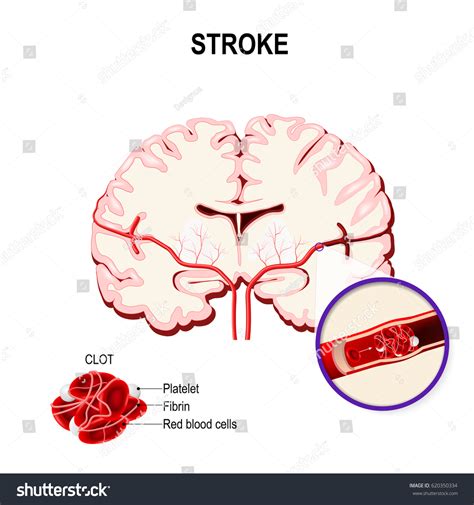 Blood Clot Human Brain Ischemic Stroke: ภาพประกอบสต็อก 620350334
