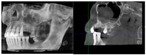 Oral Surgical Management of Bone and Soft Tissues in MRONJ Treatment: A ...