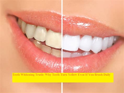 Teeth whitening truth: Why teeth turn yellow even if you brush daily