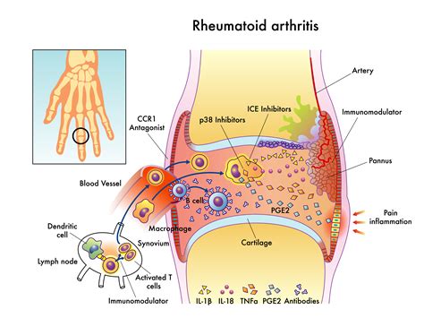 Types Of Rheumatoid Disease at Emma Sparks blog