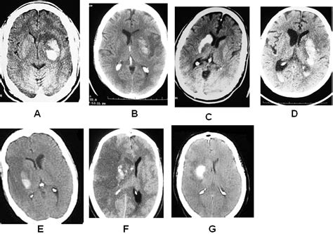 Parenchymal hematoma and total lesion volume in combined IV/IA revascularization stroke therapy ...