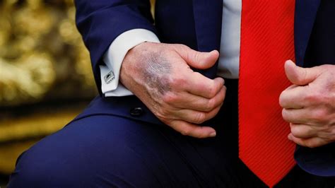 Trump appears with bruised right hand once more amid ongoing health ...