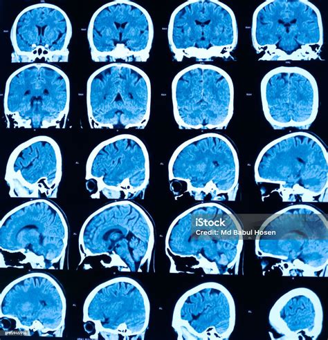 Brain CT Scan 的图像结果