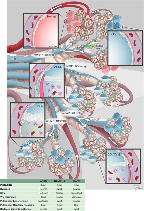 Differentiating COVID-19 Pneumonia From Acute Respiratory Distress ...