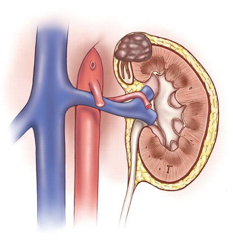 Renal Cell Carcinoma Staging