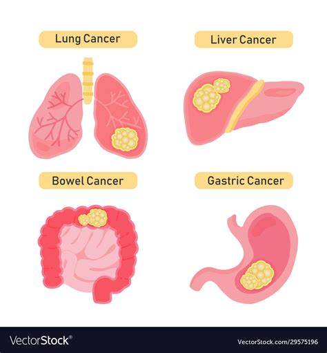 Types of Cancer Names 的图像结果