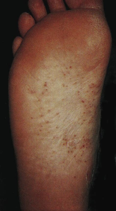 Treating A Patient With Blisters And Papules On The Soles