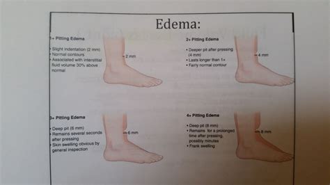 Lower Extremity Edema Grading Scale at Michael Lefroy blog