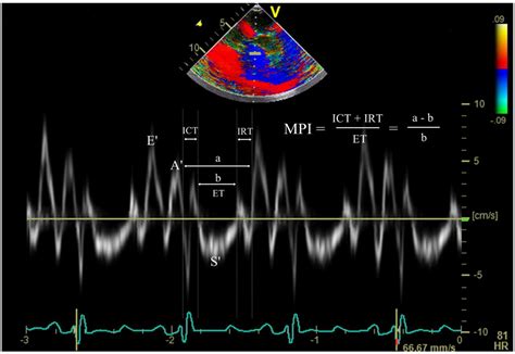 Effects of Positive End-Expiratory Pressure on Pulmonary Oxygenation ...