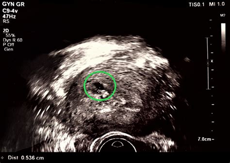 Hysteroscopic resection as a safe minimally invasive technique for the management of cornual ...
