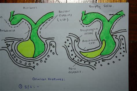 Empty sella syndrome; Empty Sella Syndrome, Primary; Empty Sella Syndrome, Secondary