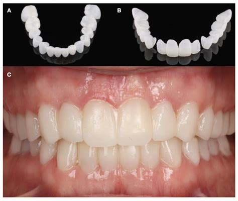 Combining Orthodontic and Restorative Care with Novel Workflows