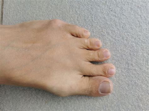 Tailor's Bunion Treatment | MIS | Powder Springs Podiatrist | Optimum Podiatry