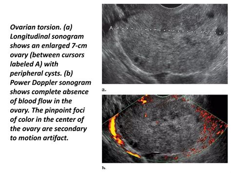 Presentation11, radiological imaging of ovarian torsion. | PPTX