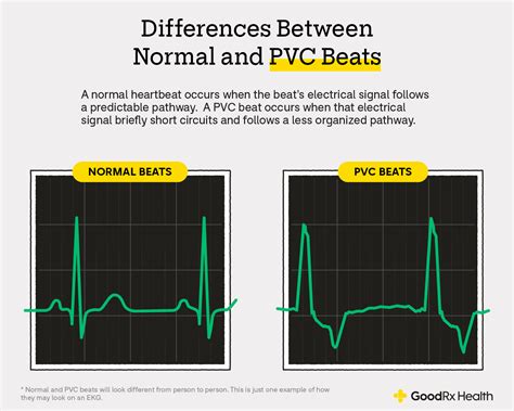 Pvc Contraction Premature Ventricular Contraction (Multiple) Vs.