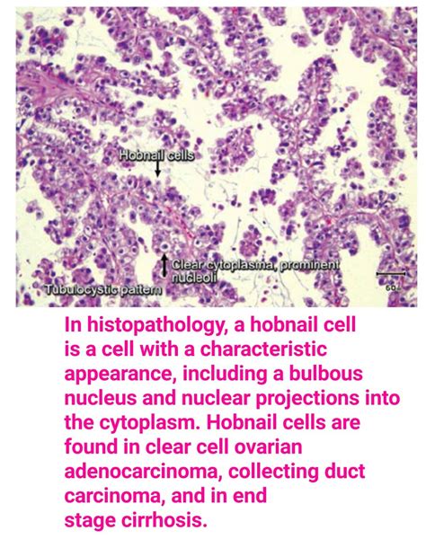 "Hobnail cell" in "Clear cell ovarian adenocarcinoma" | Ovarian, Cell ...