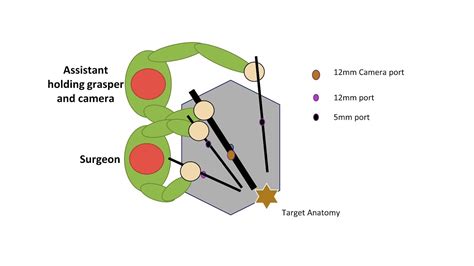 Colpotomy Procedure 的图像结果