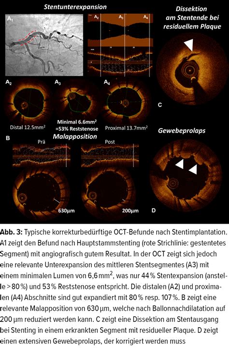 Einsatz von intrakoronarem Imaging bei perkutaner Koronarintervention ...