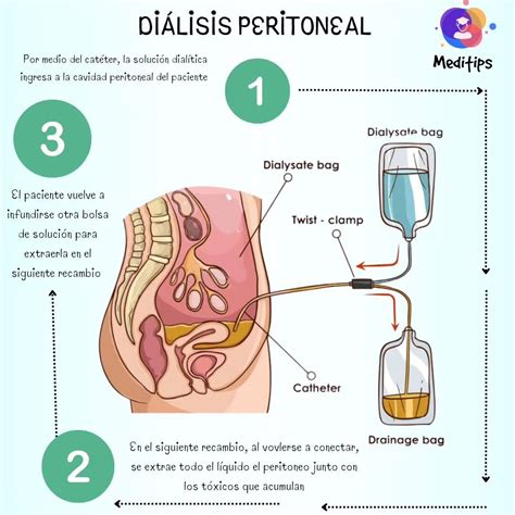 ¿Qué es la Diálisis Peritoneal? | Meditips