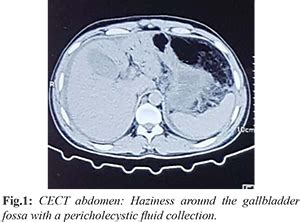 Acute Filarial Lymphangitis Presenting with Acute Abdominal Pain