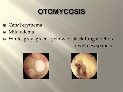 Diseases of external ear,dr.s.gopalakrishnan, 13.06.17