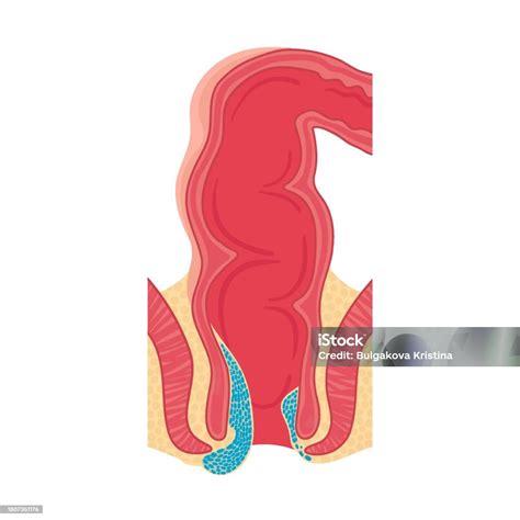 Ilustración de Hemorroides En El Recto Ilustración Vectorial En Estilo ...