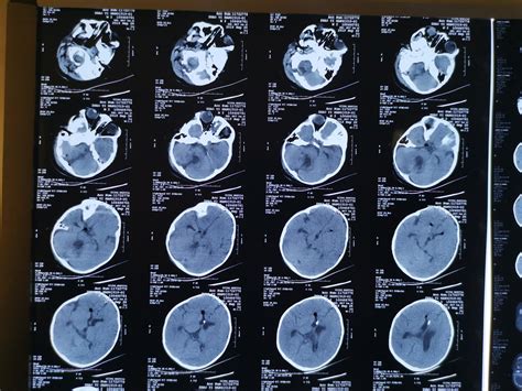 【综述】脑肿瘤治疗后影像改变（一）：影像技术 - 脑医汇 - 神外资讯 - 神介资讯