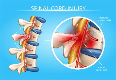 Neurogenic Shock vs. Spinal Shock | ACLS Certification Association