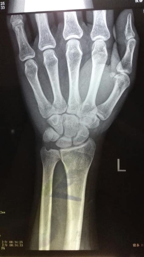医生说我左手腕三角骨骨折打石膏已3周，一直没吃药，手还有点肿，请专家帮忙看看片子，是什么情况？严重_百度知道