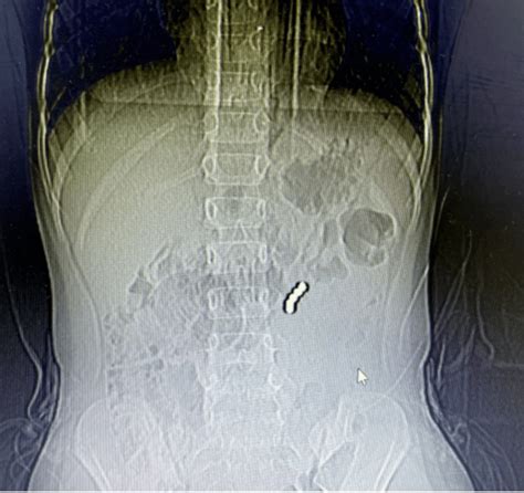 6岁女孩误吞磁力珠，医生：两处肠壁已经穿孔_孩子_文军_手术