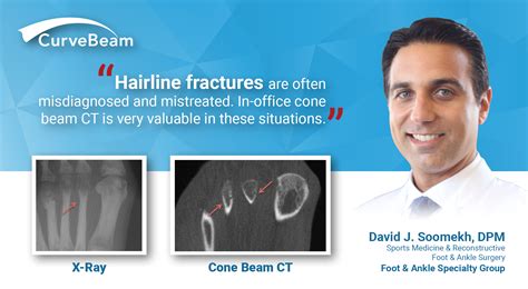 Hairline Fractures: Dx w/ In-Office CT Imaging - CurveBeam AI