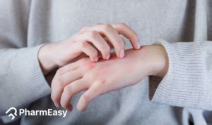 Natural Home Remedies for Scabies & Its Causes Explained | PharmEasy