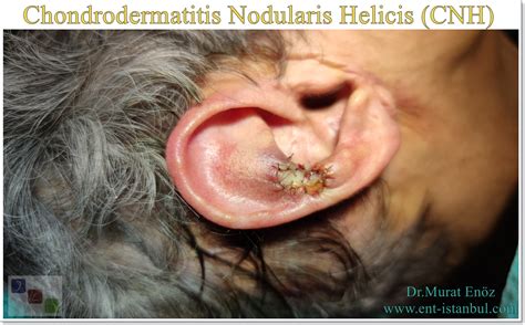 Chronic Inflammatory Lesion in the Auricle: Chondrodermatitis Nodularis ...