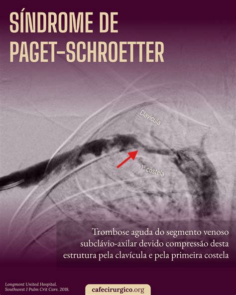 A Síndrome de Paget-Schroetter é traduzida como a trombose do segmento ...