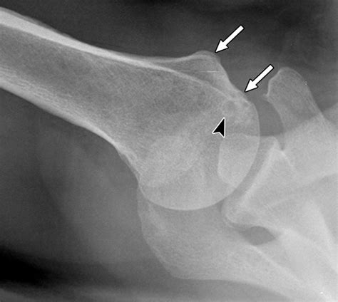 Lesser Tuberosity Humerus
