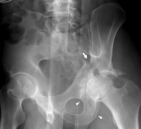 Classification of Common Acetabular Fractures: Radiographic and CT ...